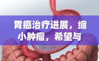 胃癌治疗进展，缩小肿瘤，希望与挑战同行