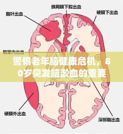 警惕老年脑健康危机，80岁突发脑淤血的重要提醒